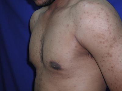 Gynecomastia Case 6096, After Treatment, Male Patient, Set 2