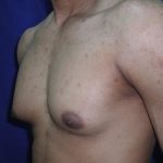 Gynecomastia Case 6096, Before Treatment, Male Patient, Thumbnail 2