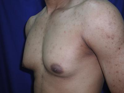 Gynecomastia Case 6096, Before Treatment, Male Patient, Set 2