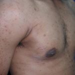 Gynecomastia Case 6096, After Treatment, Male Patient, Thumbnail 3