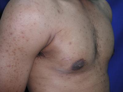 Gynecomastia Case 6096, After Treatment, Male Patient, Set 3