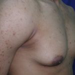 Gynecomastia Case 6096, Before Treatment, Male Patient, Thumbnail 3