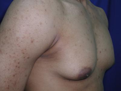 Gynecomastia Case 6096, Before Treatment, Male Patient, Set 3
