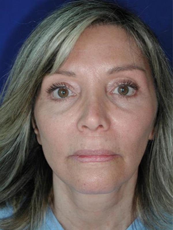 Skin Restoration After Photo