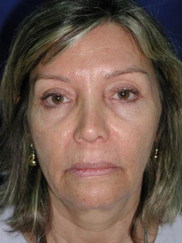 Skin Restoration Before Photo