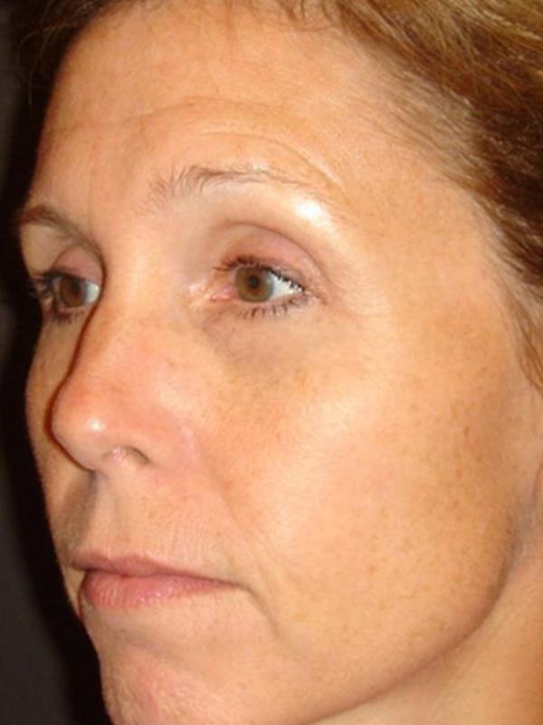 Main Photo Gallery, Case 6108, Before Treatment 