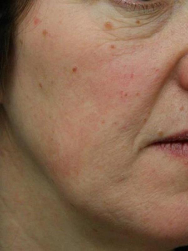 Main Photo Gallery, Case 6110, After Treatment