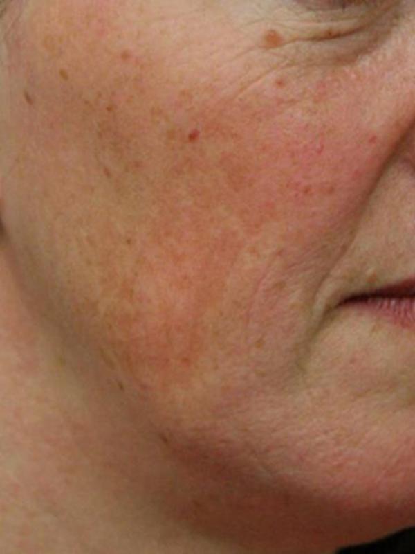 Main Photo Gallery, Case 6110, Before Treatment 