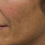 Skin Restoration Case 6111, Before Treatment, Female Patient, Thumbnail 1