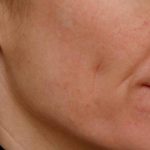 Skin Restoration Case 6111, After Treatment, Female Patient, Thumbnail 2