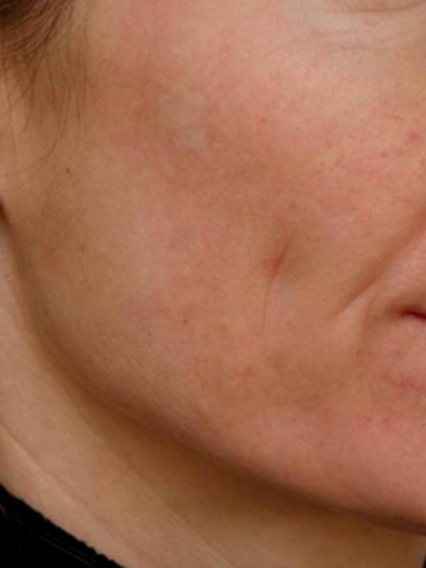 Skin Restoration Case 6111, After Treatment, Female Patient, Set 2