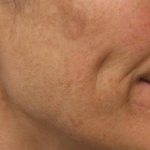 Skin Restoration Case 6111, Before Treatment, Female Patient, Thumbnail 2