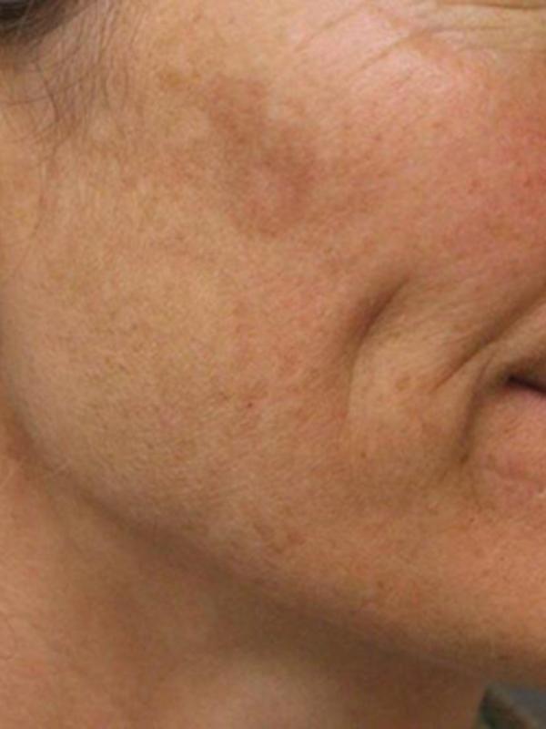 Skin Restoration Case 6111, Before Treatment, Female Patient, Set 2