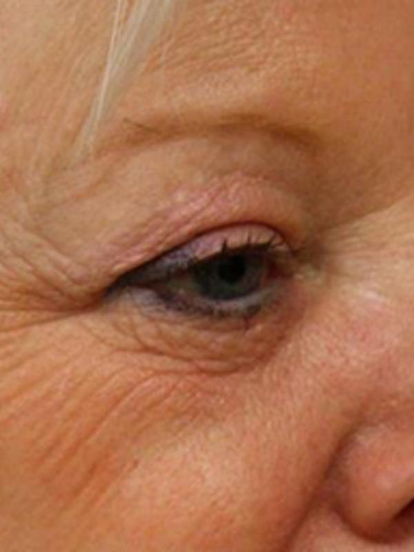 Skin Restoration Case 6112, Before Treatment, Female Patient, Set 2
