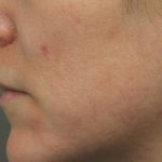Skin Restoration Case 6122, After Treatment, Female Patient, Thumbnail 1