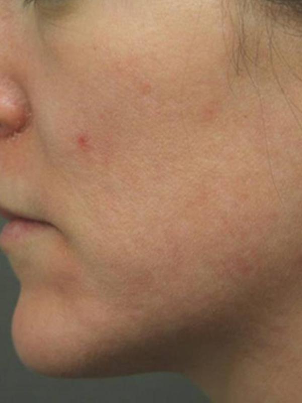 Skin Restoration Case 6122, After Treatment, Female Patient, Set 1