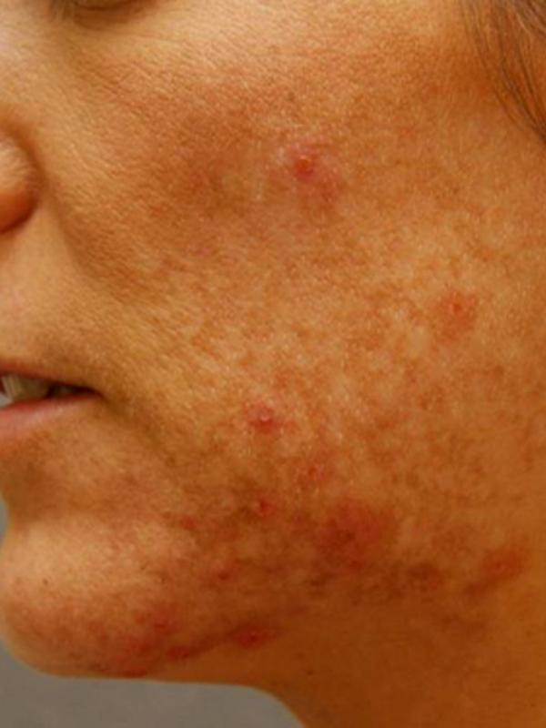Skin Restoration Case 6122, Before Treatment, Female Patient, Set 1