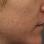 Skin Restoration Case 6122, After Treatment, Female Patient, Thumbnail 2