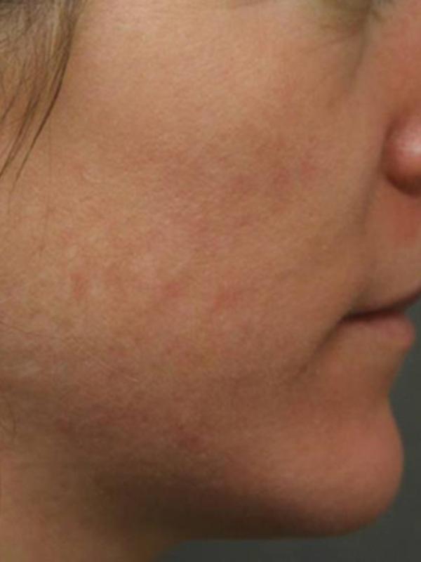 Skin Restoration Case 6122, After Treatment, Female Patient, Set 2