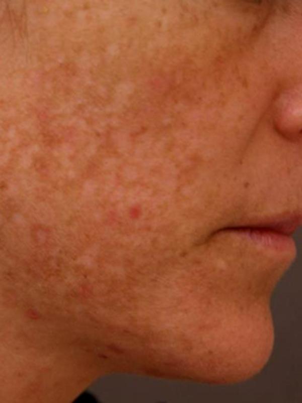 Skin Restoration Case 6122, Before Treatment, Female Patient, Set 2