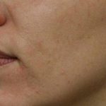 Skin Restoration Case 6124, After Treatment, Female Patient, Thumbnail 1