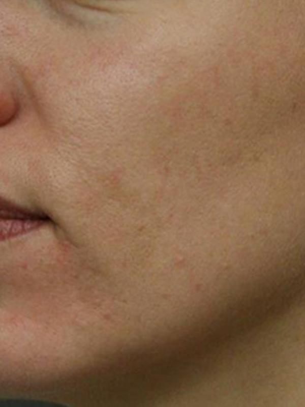 Skin Restoration Case 6124, After Treatment, Female Patient, Set 1
