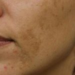 Skin Restoration Case 6124, Before Treatment, Female Patient, Thumbnail 1