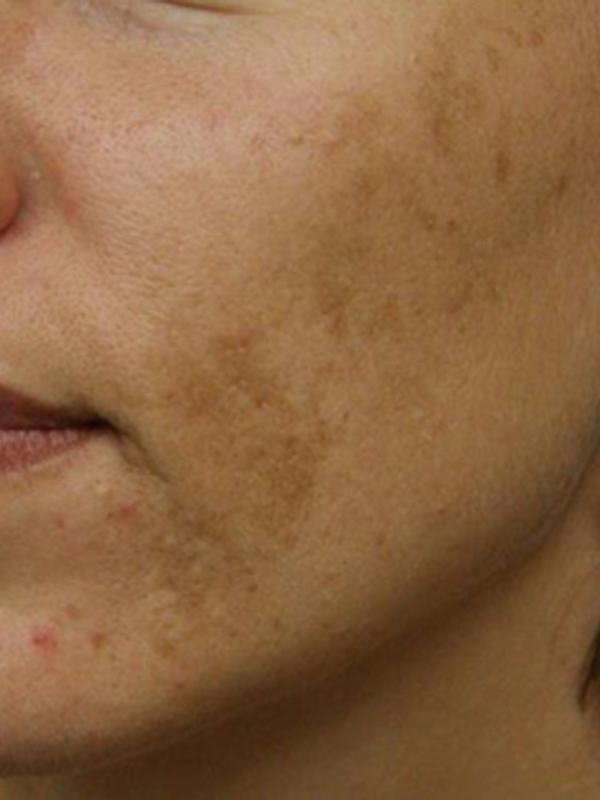 Skin Restoration Case 6124, Before Treatment, Female Patient, Set 1