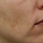 Skin Restoration Case 6124, After Treatment, Female Patient, Thumbnail 2