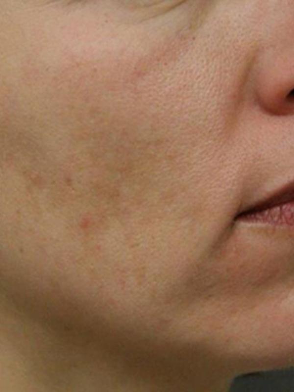 Skin Restoration Case 6124, After Treatment, Female Patient, Set 2