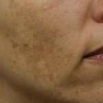 Skin Restoration Case 6124, Before Treatment, Female Patient, Thumbnail 2
