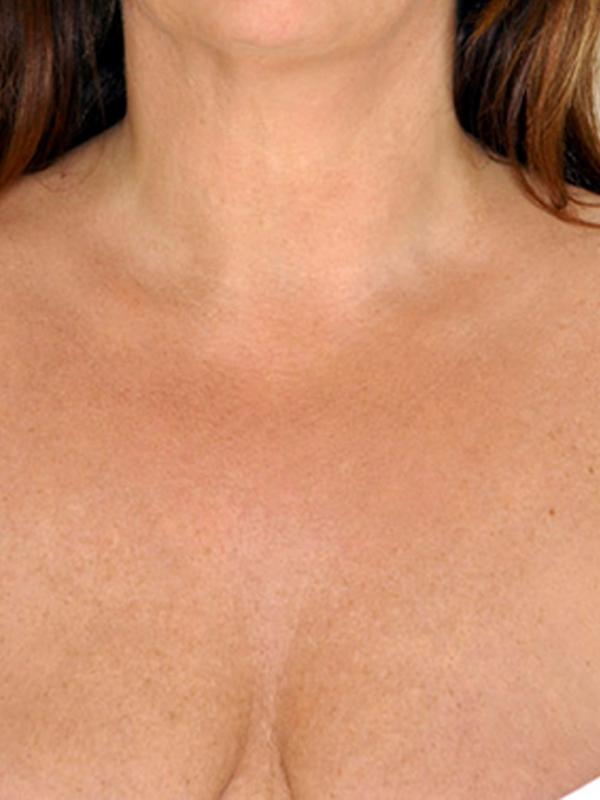 Skin Restoration Case 6125, After Treatment, Female Patient, Set 1