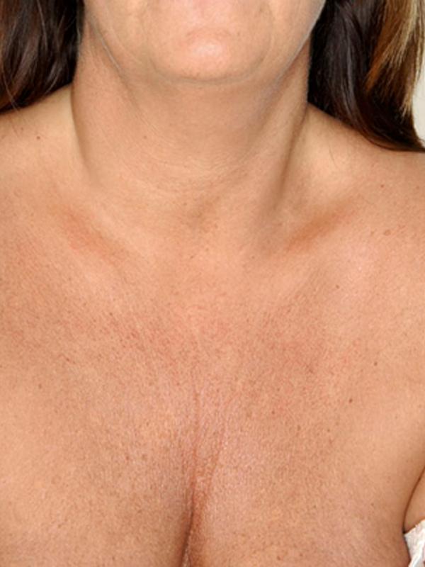 Skin Restoration Case 6125, Before Treatment, Female Patient, Set 1