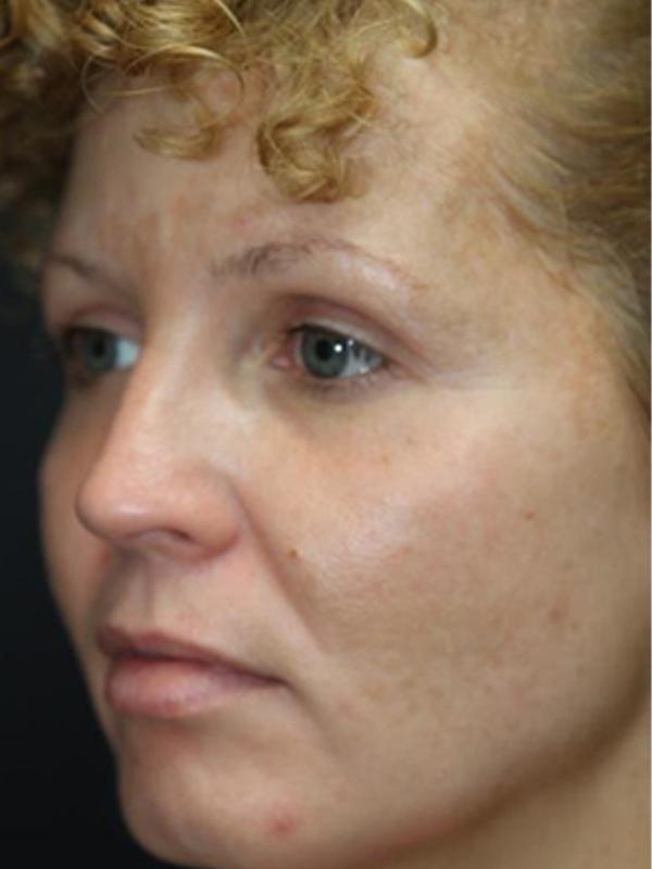 Skin Restoration Case 6128, After Treatment, Female Patient, Set 1