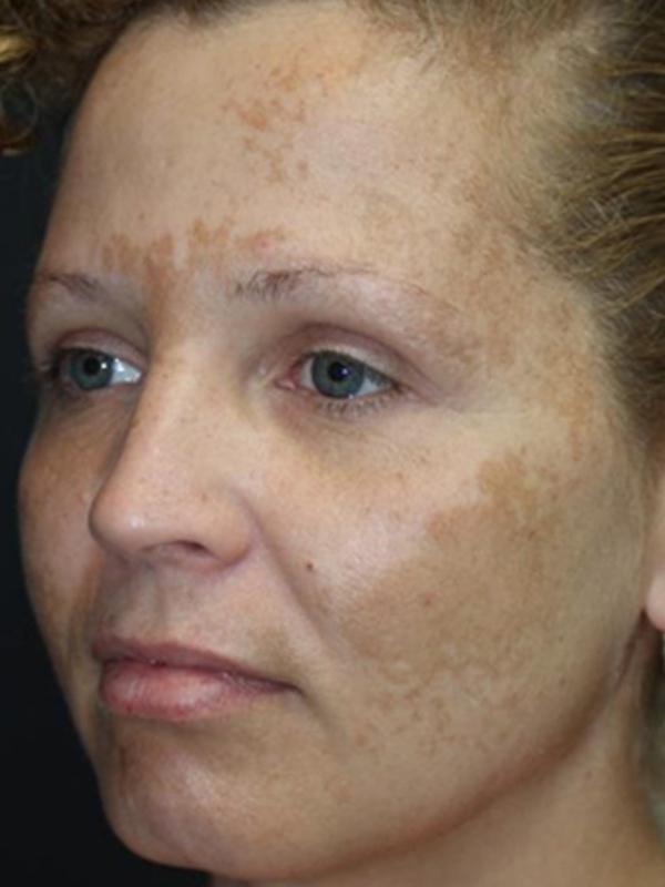 Skin Restoration Case 6128, Before Treatment, Female Patient, Set 1