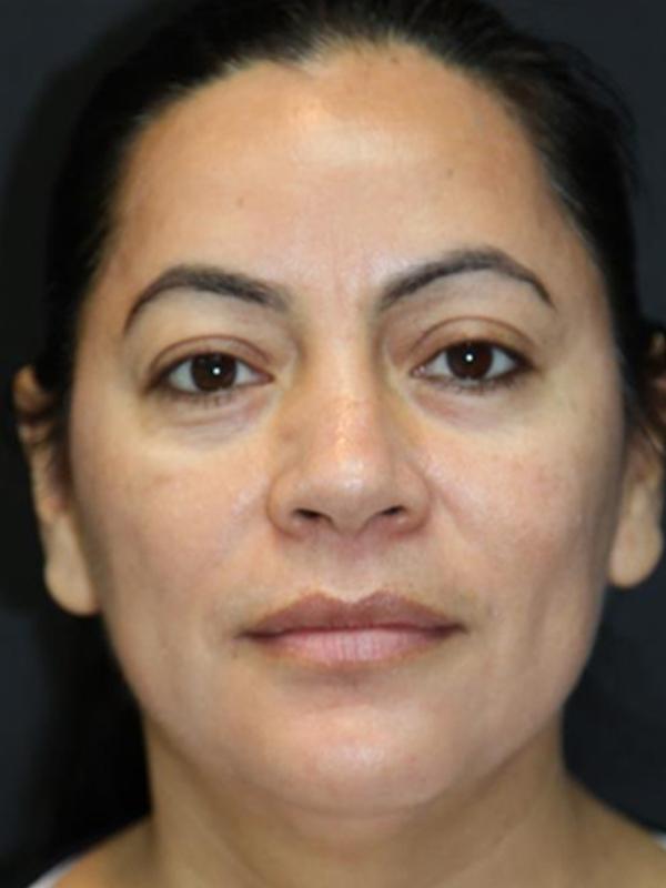 Skin Restoration Case 6129, After Treatment, Female Patient, Set 1