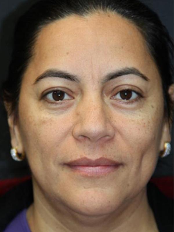 Skin Restoration Case 6129, Before Treatment, Female Patient, Set 1