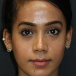 Skin Restoration Case 6131, After Treatment, Female Patient, Thumbnail 1