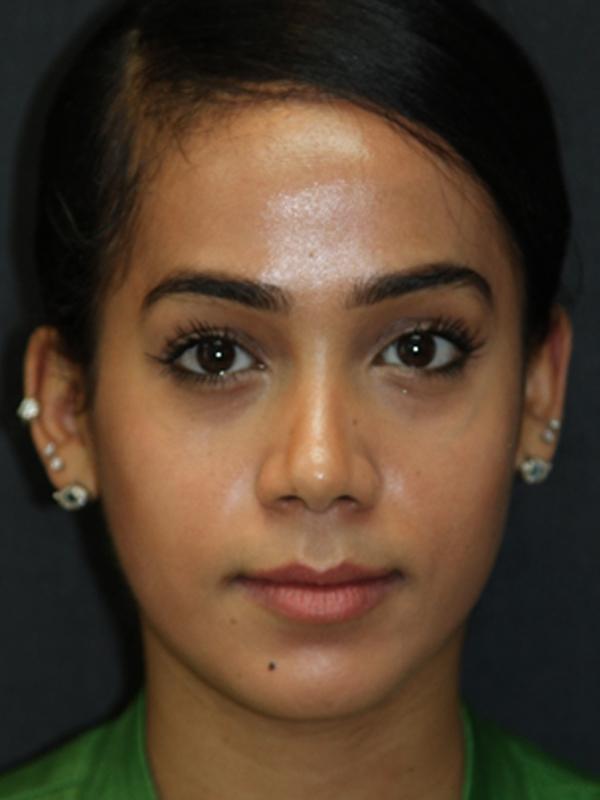 Skin Restoration Case 6131, After Treatment, Female Patient, Set 1