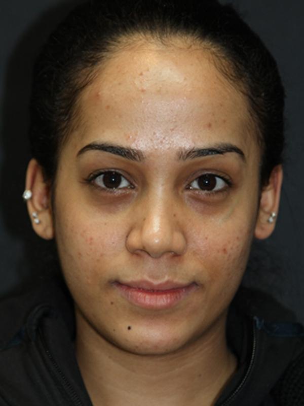Skin Restoration Case 6131, Before Treatment, Female Patient, Set 1