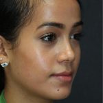 Skin Restoration Case 6131, After Treatment, Female Patient, Thumbnail 2