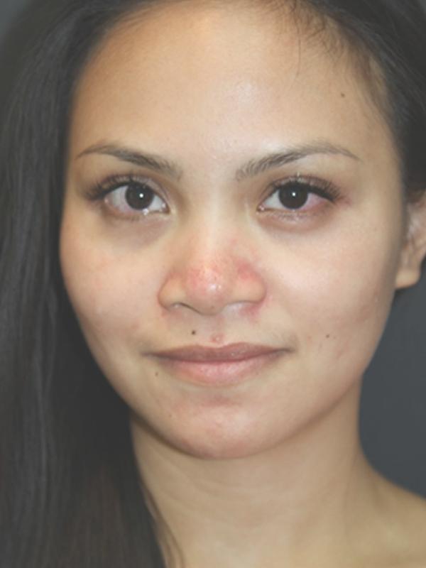 Skin Restoration Case 6132, After Treatment, Female Patient, Set 1