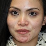 Skin Restoration Case 6132, Before Treatment, Female Patient, Thumbnail 1