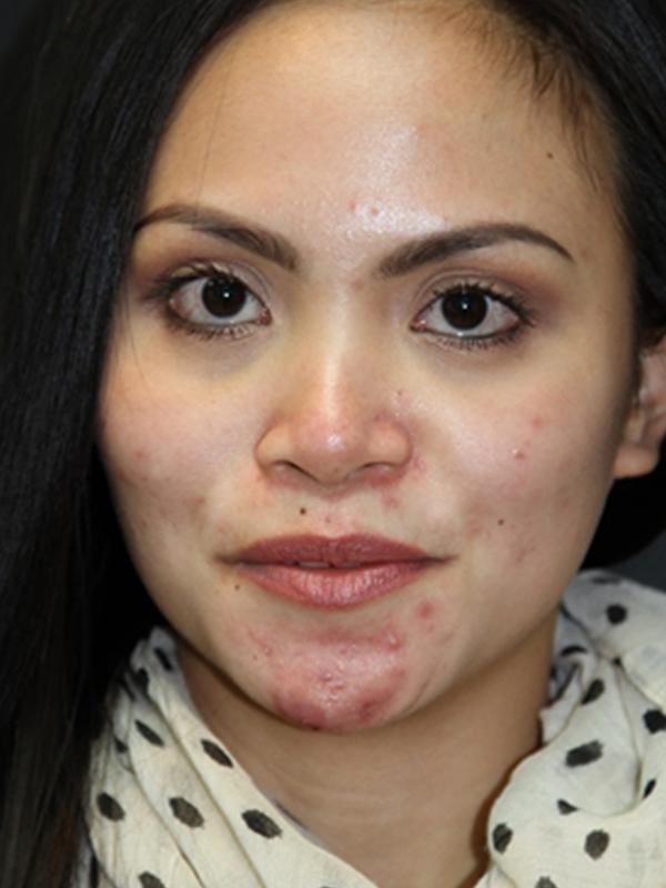 Skin Restoration Case 6132, Before Treatment, Female Patient, Set 1
