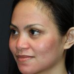 Skin Restoration Case 6132, After Treatment, Female Patient, Thumbnail 2