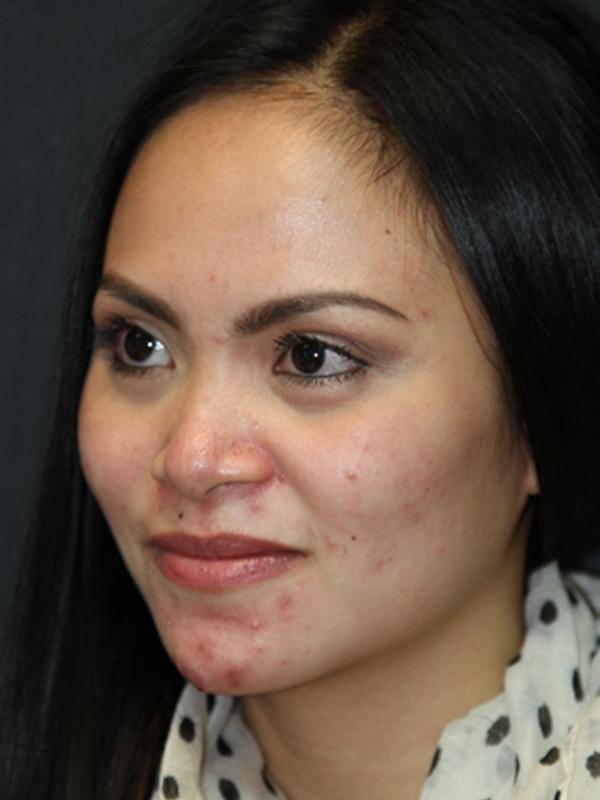 Skin Restoration Case 6132, Before Treatment, Female Patient, Set 2