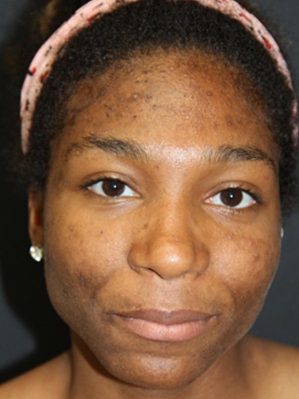 Skin Restoration Case 6133, Before Treatment, Female Patient, Set 1