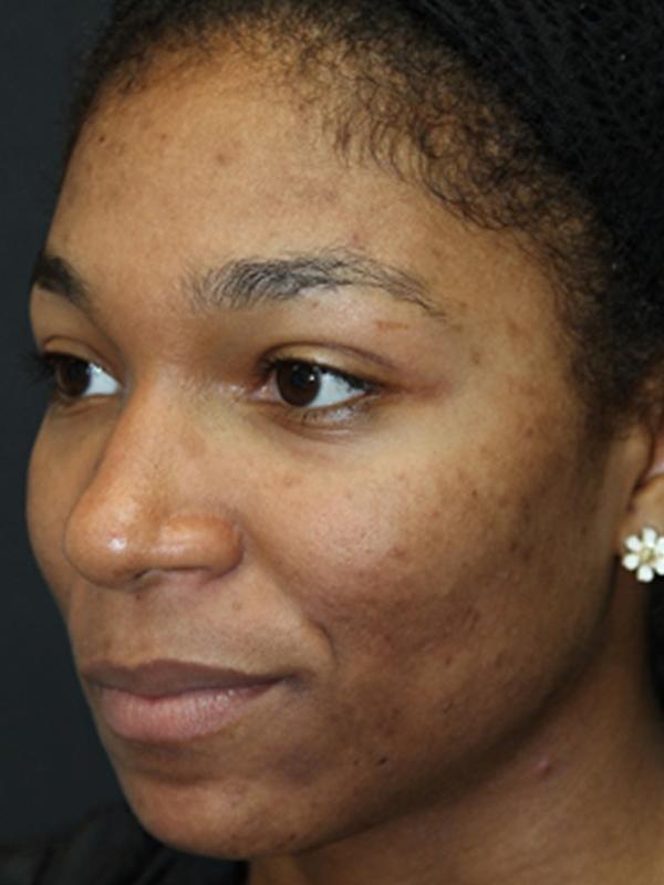 Skin Restoration Case 6133, After Treatment, Female Patient, Set 2