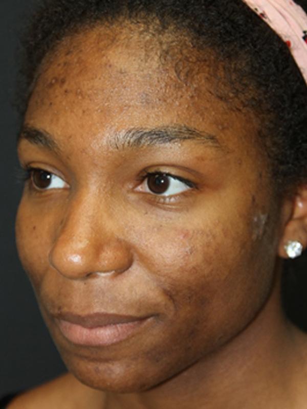 Skin Restoration Case 6133, Before Treatment, Female Patient, Set 2