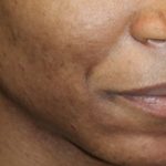 Skin Restoration Case 6133, After Treatment, Female Patient, Thumbnail 3